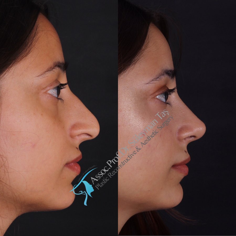 Dr. Suleyman Tas MD, Aesthetic and Plastic Surgeon - Dr. Suleyman Tas MD, Aesthetic and Plastic Surgeon