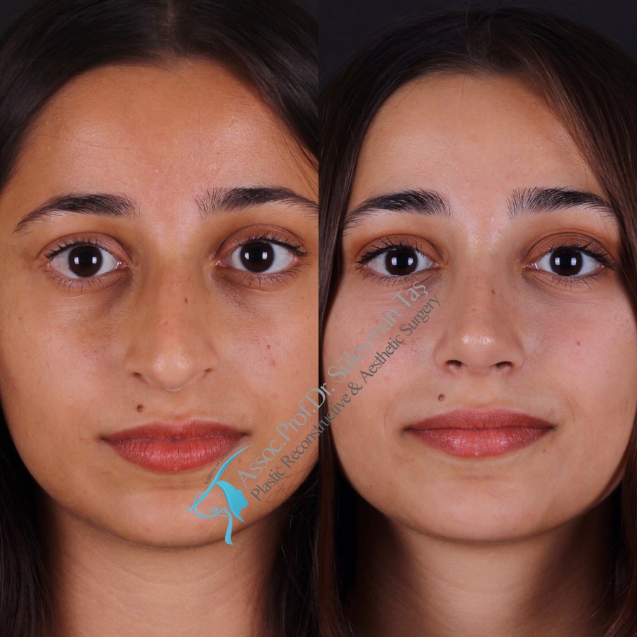 Dr. Suleyman Tas MD, Aesthetic and Plastic Surgeon - Dr. Suleyman Tas MD, Aesthetic and Plastic Surgeon