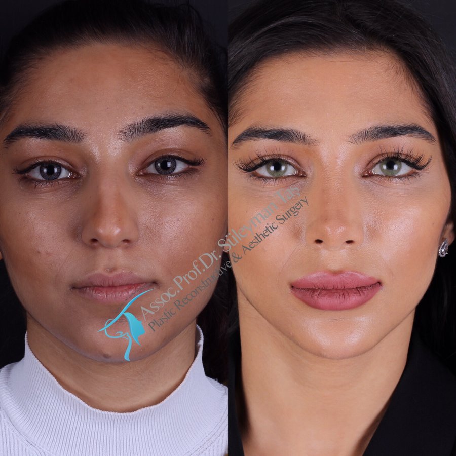 Dr. Suleyman Tas MD, Aesthetic and Plastic Surgeon - Dr. Suleyman Tas MD, Aesthetic and Plastic Surgeon