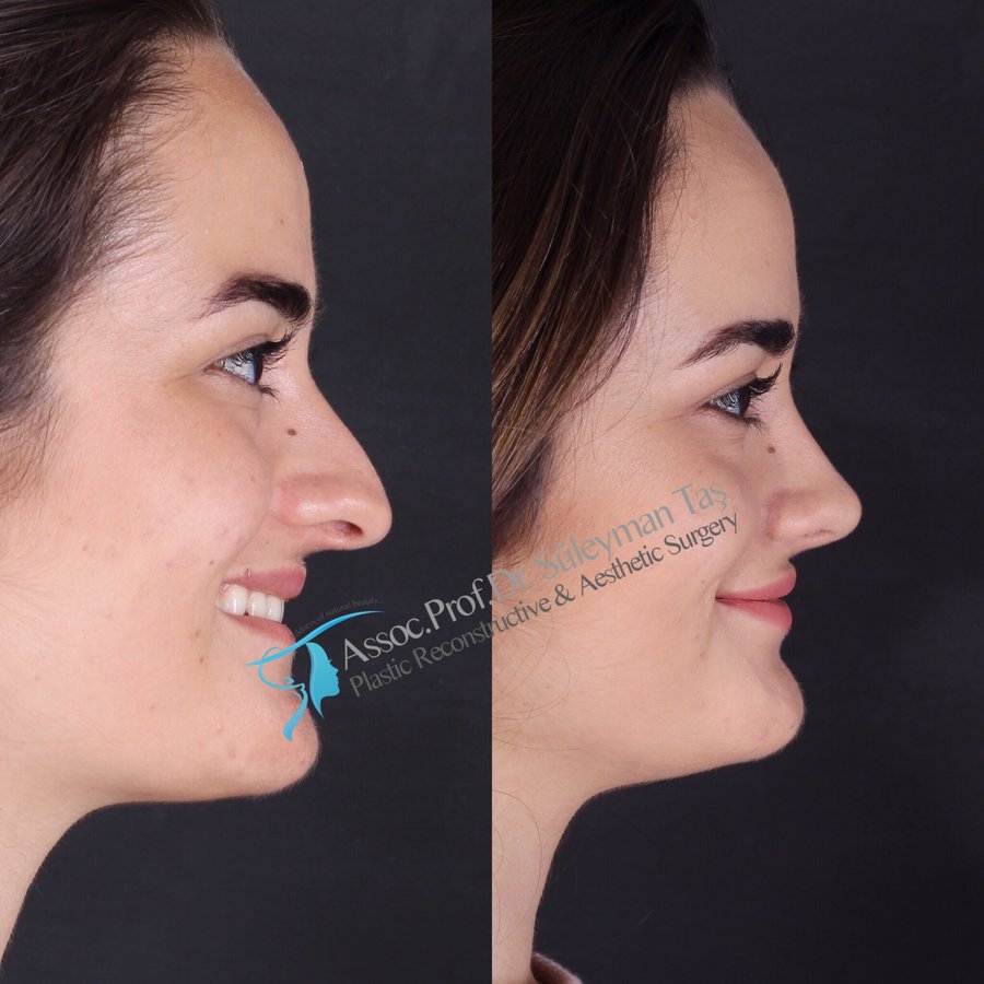 Dr. Suleyman Tas MD, Aesthetic and Plastic Surgeon - Dr. Suleyman Tas MD, Aesthetic and Plastic Surgeon