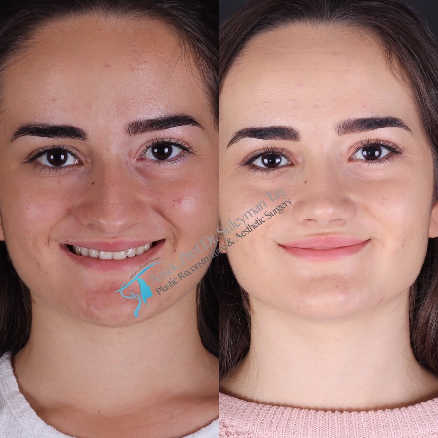 Dr. Suleyman Tas MD, Aesthetic and Plastic Surgeon - Dr. Suleyman Tas MD, Aesthetic and Plastic Surgeon