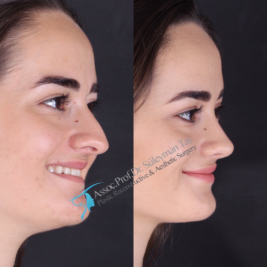 Dr. Suleyman Tas MD, Aesthetic and Plastic Surgeon - Dr. Suleyman Tas MD, Aesthetic and Plastic Surgeon