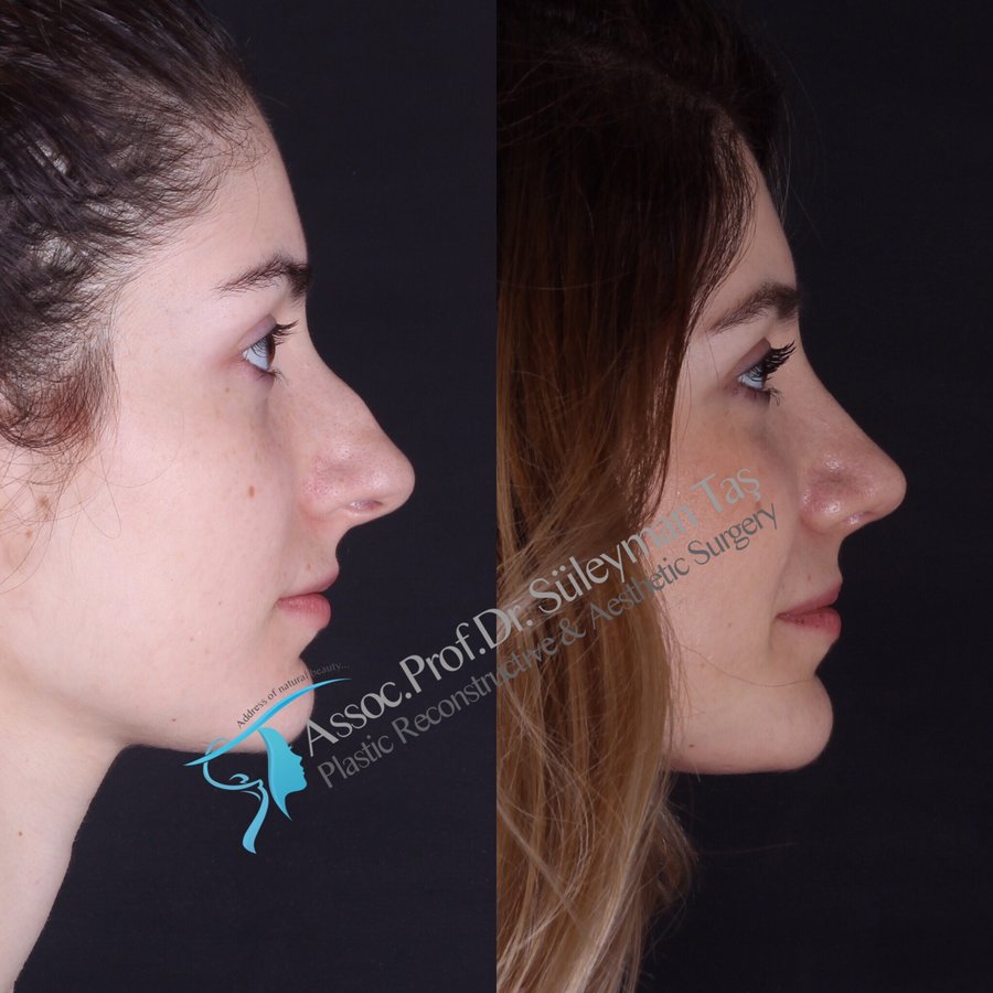 Dr. Suleyman Tas MD, Aesthetic and Plastic Surgeon - Dr. Suleyman Tas MD, Aesthetic and Plastic Surgeon