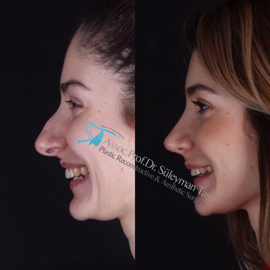 Dr. Suleyman Tas MD, Aesthetic and Plastic Surgeon - Dr. Suleyman Tas MD, Aesthetic and Plastic Surgeon