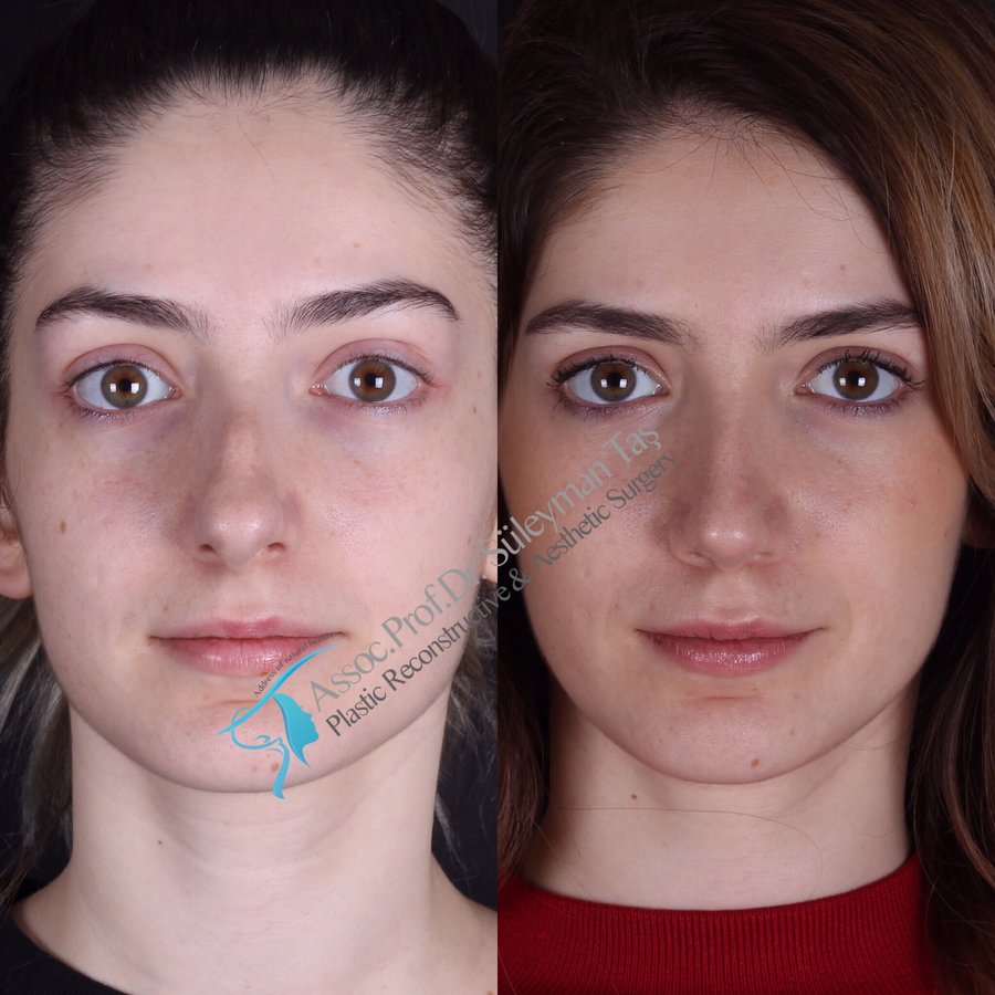 Dr. Suleyman Tas MD, Aesthetic and Plastic Surgeon - Dr. Suleyman Tas MD, Aesthetic and Plastic Surgeon