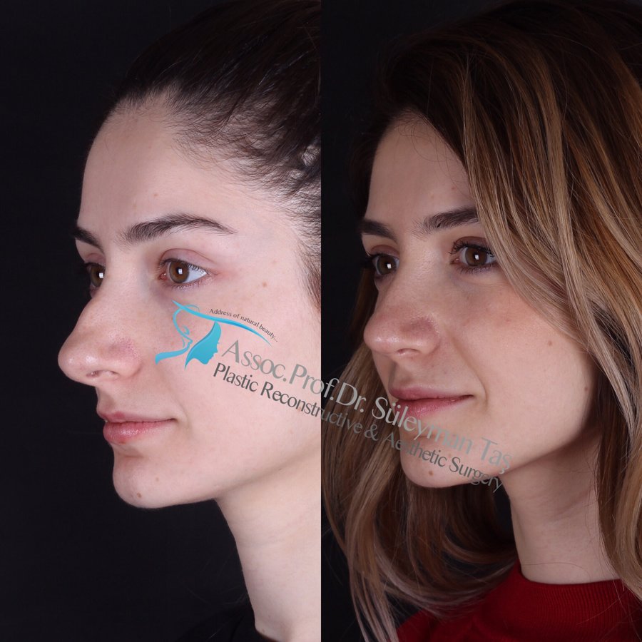 Dr. Suleyman Tas MD, Aesthetic and Plastic Surgeon - Dr. Suleyman Tas MD, Aesthetic and Plastic Surgeon