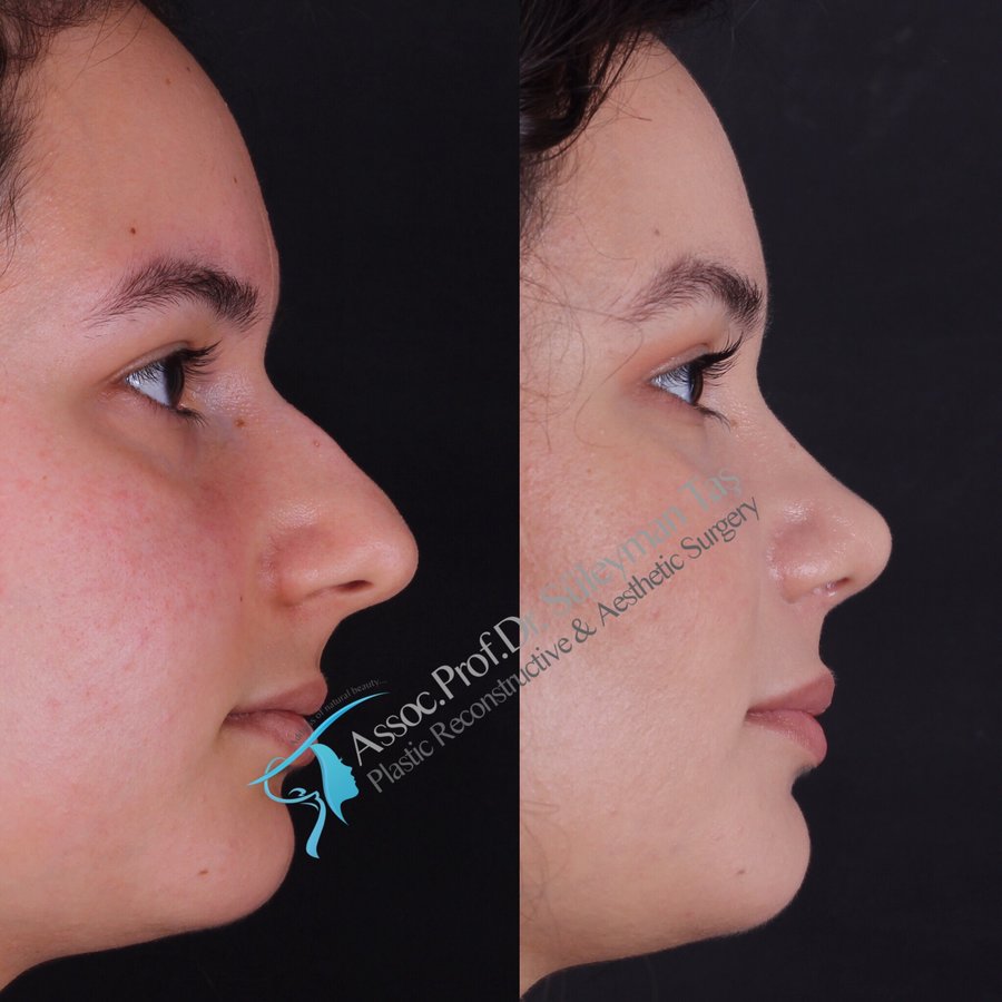 Dr. Suleyman Tas MD, Aesthetic and Plastic Surgeon - Dr. Suleyman Tas MD, Aesthetic and Plastic Surgeon