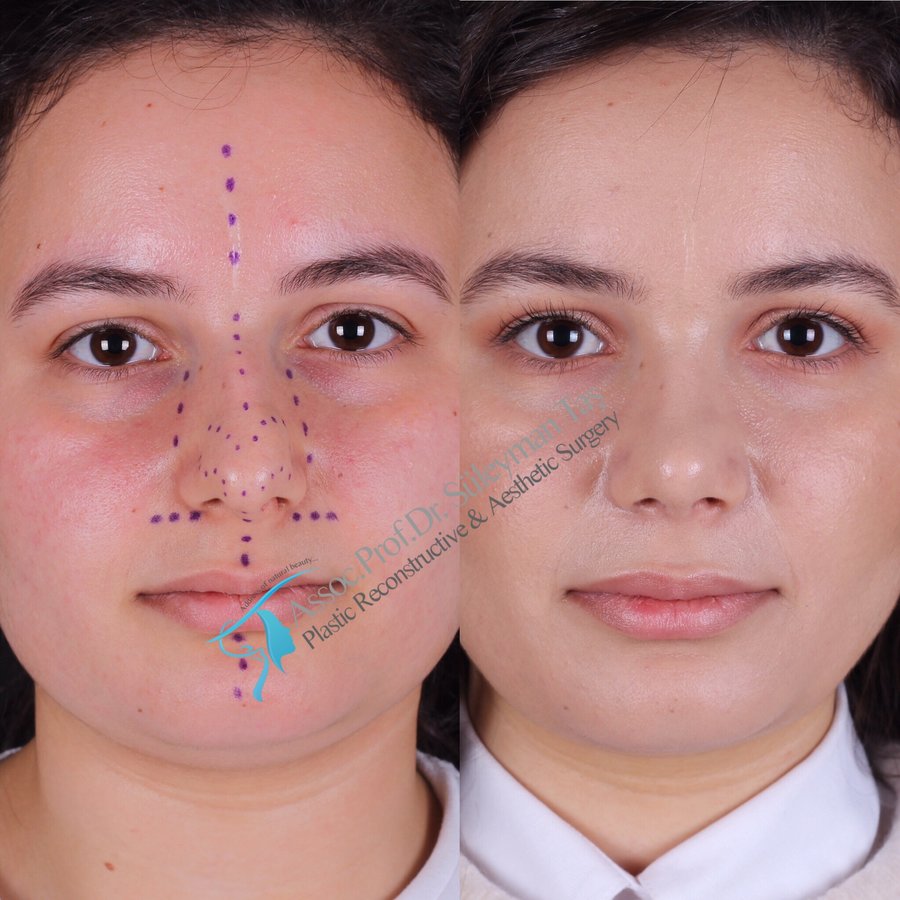 Dr. Suleyman Tas MD, Aesthetic and Plastic Surgeon - Dr. Suleyman Tas MD, Aesthetic and Plastic Surgeon