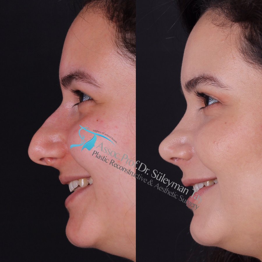 Dr. Suleyman Tas MD, Aesthetic and Plastic Surgeon - Dr. Suleyman Tas MD, Aesthetic and Plastic Surgeon