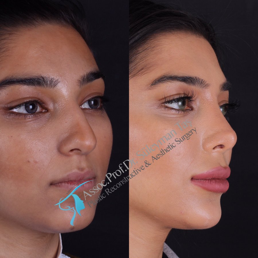 Dr. Suleyman Tas MD, Aesthetic and Plastic Surgeon - Dr. Suleyman Tas MD, Aesthetic and Plastic Surgeon