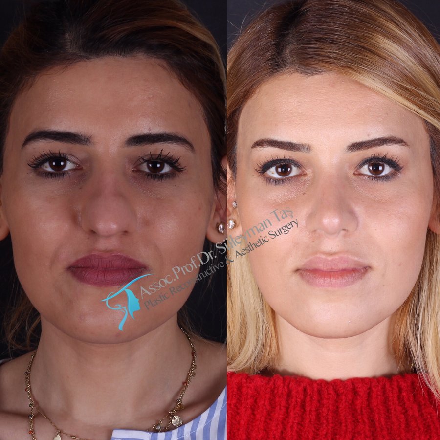 Dr. Suleyman Tas MD, Aesthetic and Plastic Surgeon - Dr. Suleyman Tas MD, Aesthetic and Plastic Surgeon