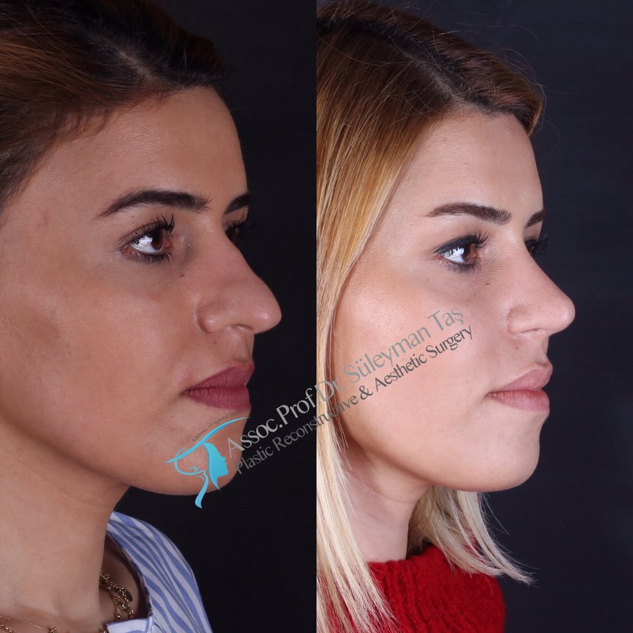 Dr. Suleyman Tas MD, Aesthetic and Plastic Surgeon - Dr. Suleyman Tas MD, Aesthetic and Plastic Surgeon