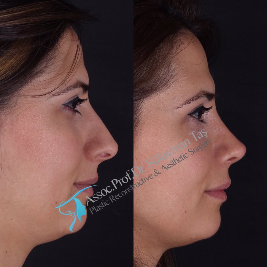 Dr. Suleyman Tas MD, Aesthetic and Plastic Surgeon - Dr. Suleyman Tas MD, Aesthetic and Plastic Surgeon