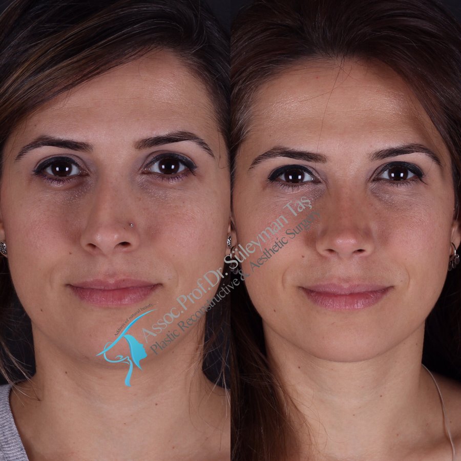 Dr. Suleyman Tas MD, Aesthetic and Plastic Surgeon - Dr. Suleyman Tas MD, Aesthetic and Plastic Surgeon