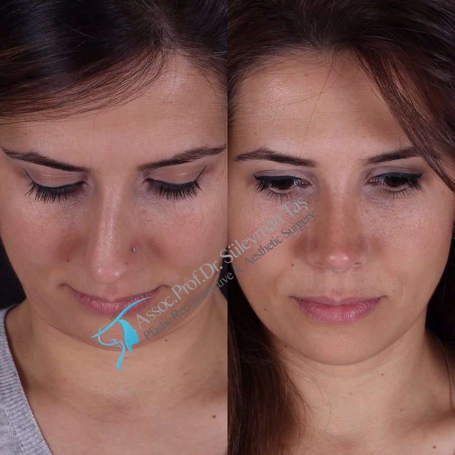 Dr. Suleyman Tas MD, Aesthetic and Plastic Surgeon - Dr. Suleyman Tas MD, Aesthetic and Plastic Surgeon