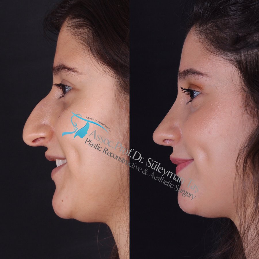 Dr. Suleyman Tas MD, Aesthetic and Plastic Surgeon - Dr. Suleyman Tas MD, Aesthetic and Plastic Surgeon