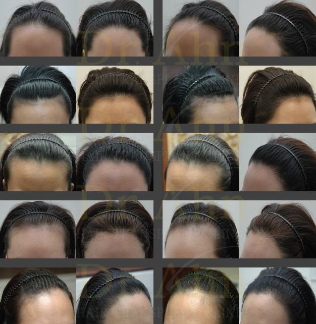 Dr.Ahn Hair Transplant Clinic - Dr.Ahn Hair Transplant Clinic