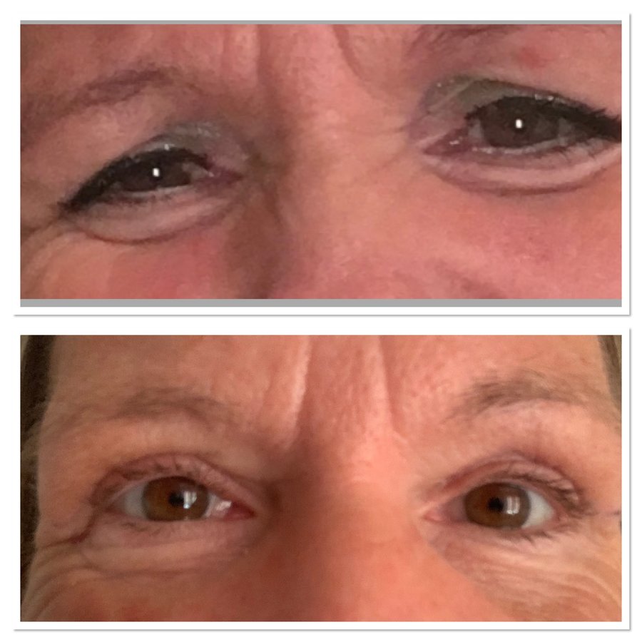 Dr.Emir Doğan - Oculoplastic Surgery - Dr.Emir Doğan - Oculoplastic Surgery