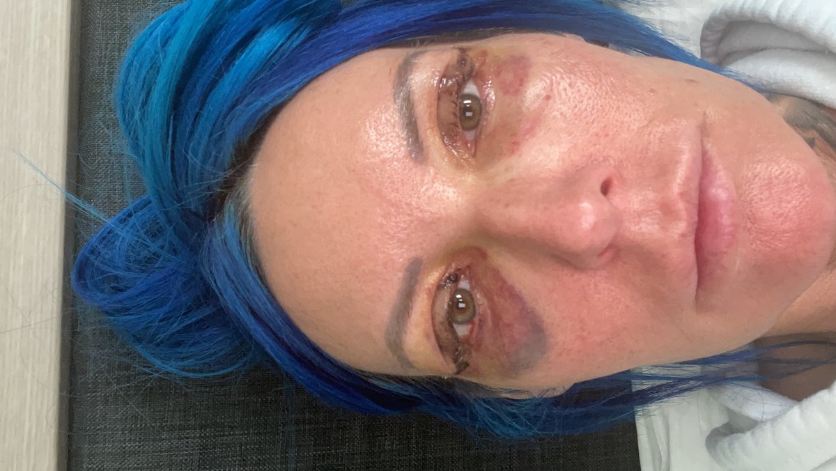 Dr.Emir Doğan - Oculoplastic Surgery - Dr.Emir Doğan - Oculoplastic Surgery