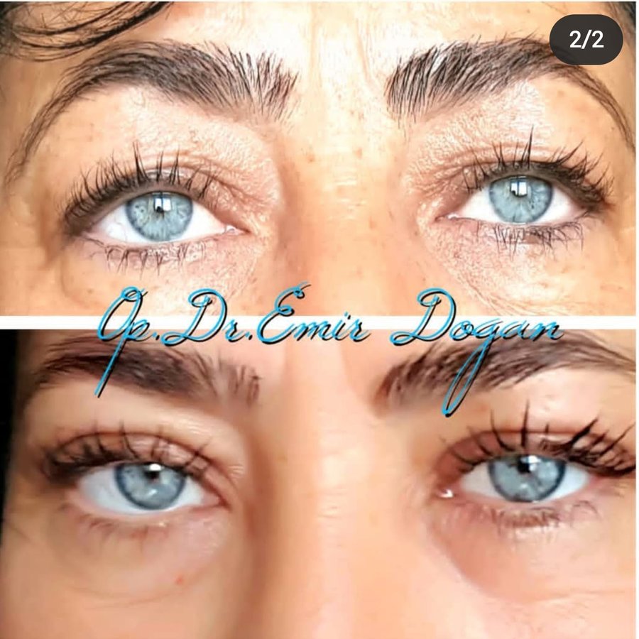 Dr.Emir Doğan - Oculoplastic Surgery - Dr.Emir Doğan - Oculoplastic Surgery