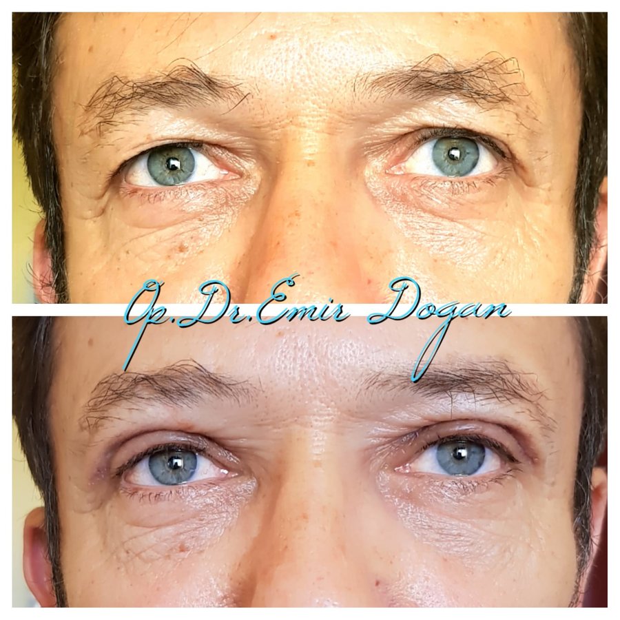 Dr.Emir Doğan - Oculoplastic Surgery - Dr.Emir Doğan - Oculoplastic Surgery