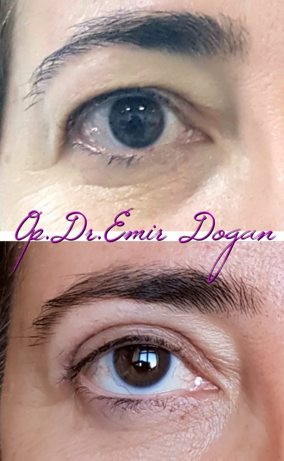 Dr.Emir Doğan - Oculoplastic Surgery - Dr.Emir Doğan - Oculoplastic Surgery