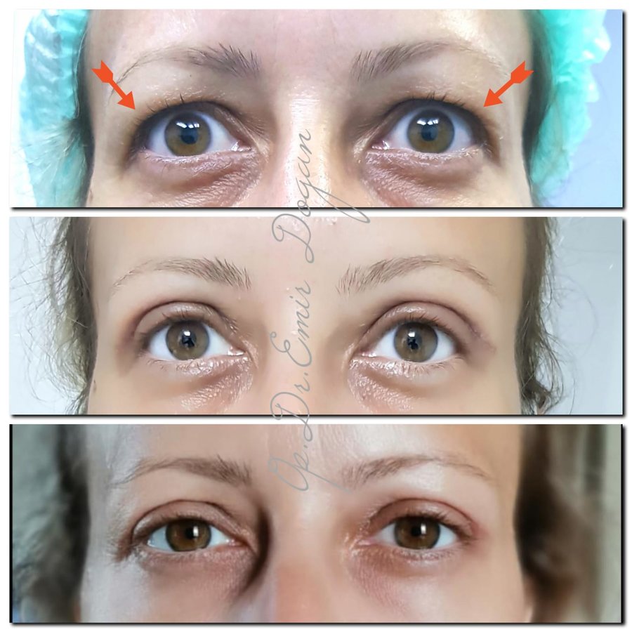 Dr.Emir Doğan - Oculoplastic Surgery - Dr.Emir Doğan - Oculoplastic Surgery