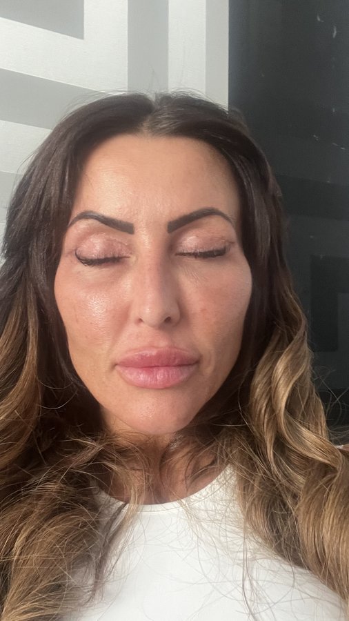 Dr.Emir Doğan - Oculoplastic Surgery - Dr.Emir Doğan - Oculoplastic Surgery