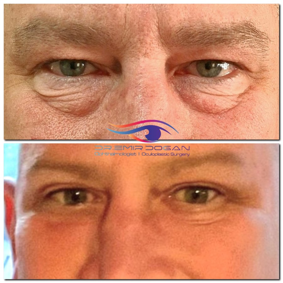 Dr.Emir Doğan - Oculoplastic Surgery - Dr.Emir Doğan - Oculoplastic Surgery