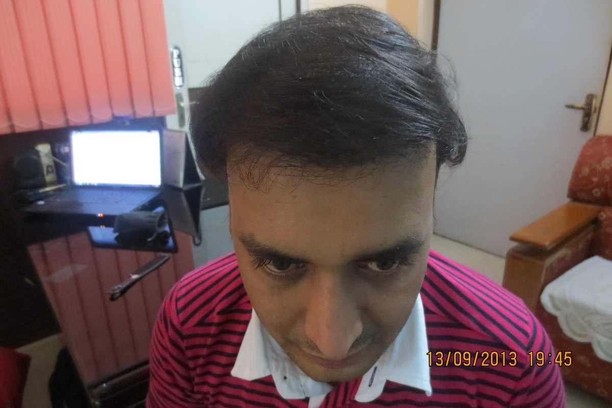 Dr.Khan's exclusive hair transplant center - Banjara Hills - Dr.Khan's exclusive hair transplant center - Banjara Hills