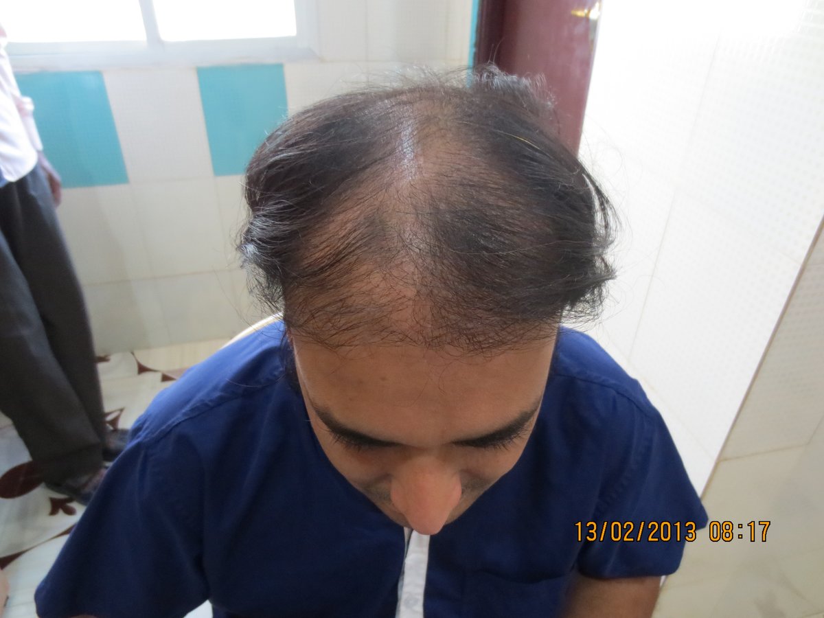 Dr.Khan's exclusive hair transplant center - Banjara Hills - Dr.Khan's exclusive hair transplant center - Banjara Hills