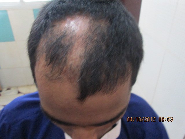 Dr.Khan's exclusive hair transplant center - Banjara Hills - Dr.Khan's exclusive hair transplant center - Banjara Hills