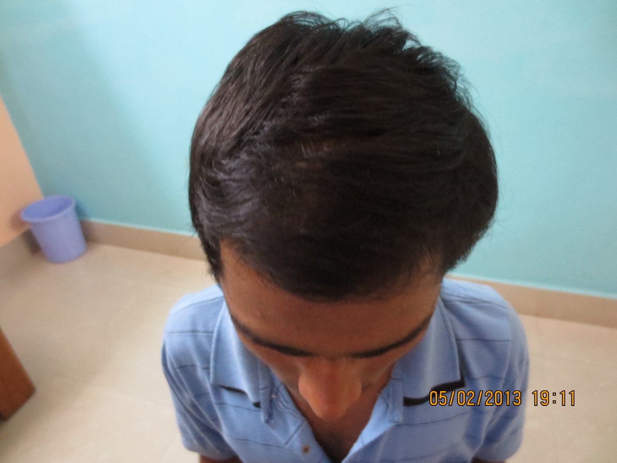 Dr.Khan's exclusive hair transplant center - Banjara Hills - Dr.Khan's exclusive hair transplant center - Banjara Hills