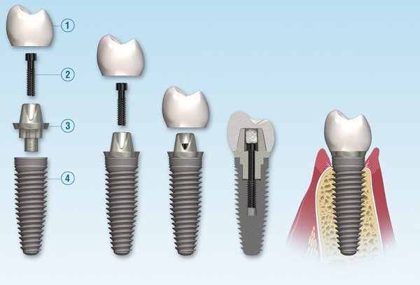 Dr.Motiwala Dental Clinic and Implant Center - Dr.Motiwala Dental Clinic and Implant Center