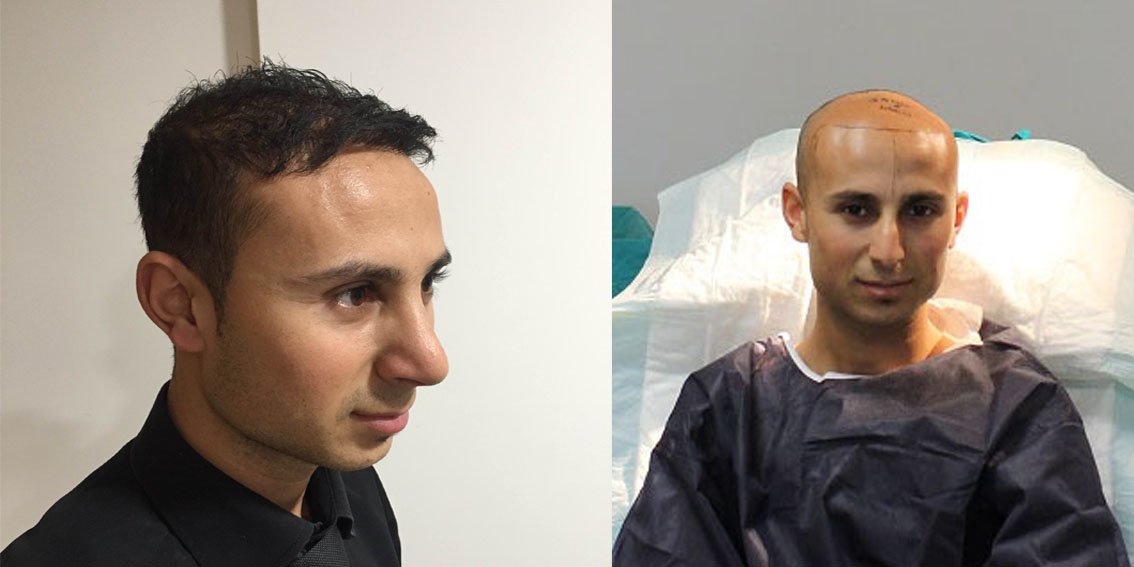 مركز ENTO الطبي عيادة زراعة الشعر - ENTO Medical Center Hair Transplant Clinic