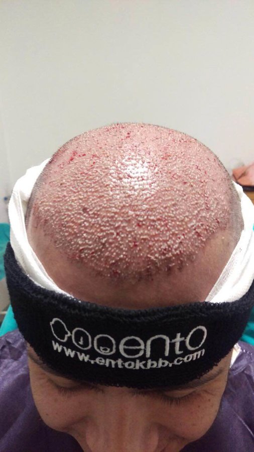 مركز ENTO الطبي عيادة زراعة الشعر - ENTO Medical Center Hair Transplant Clinic