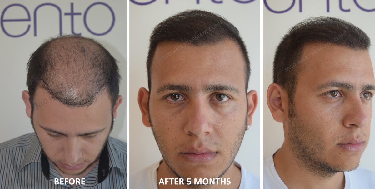 مركز ENTO الطبي عيادة زراعة الشعر - ENTO Medical Center Hair Transplant Clinic
