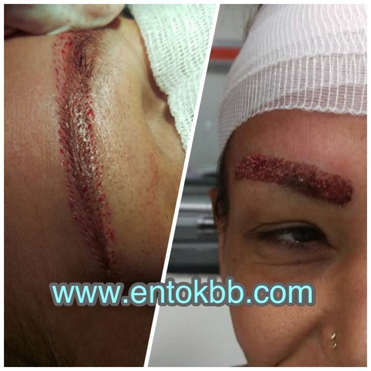 مركز ENTO الطبي عيادة زراعة الشعر - ENTO Medical Center Hair Transplant Clinic