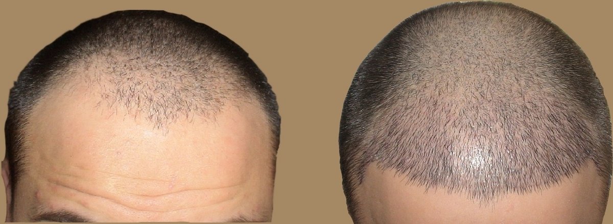 مركز ENTO الطبي عيادة زراعة الشعر - ENTO Medical Center Hair Transplant Clinic