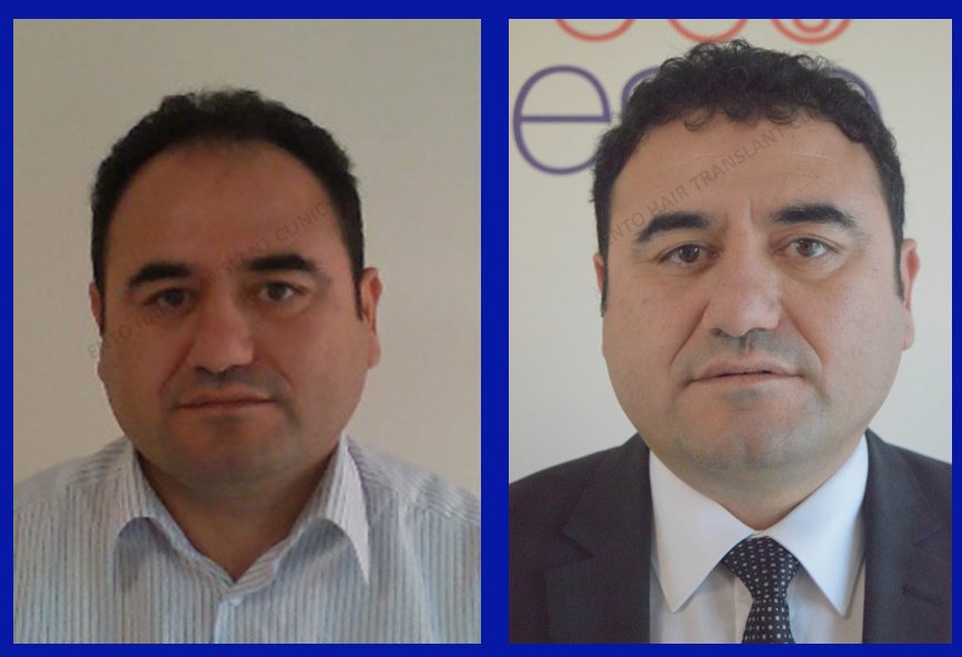 مركز ENTO الطبي عيادة زراعة الشعر - ENTO Medical Center Hair Transplant Clinic