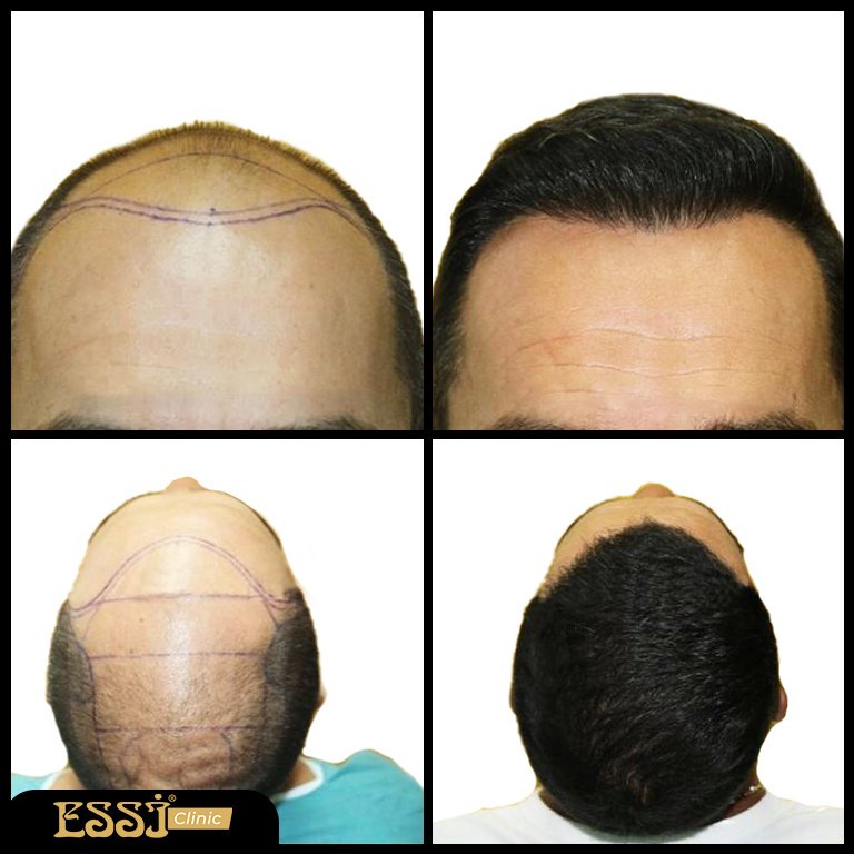 عيادة اسي لزراعة الشعر - Essi Hair Transplant Clinic