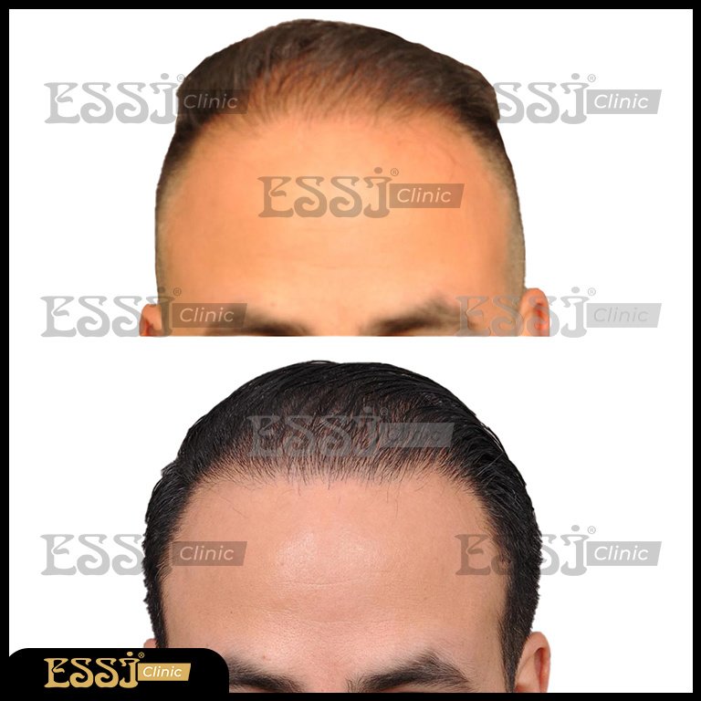 عيادة اسي لزراعة الشعر - Essi Hair Transplant Clinic