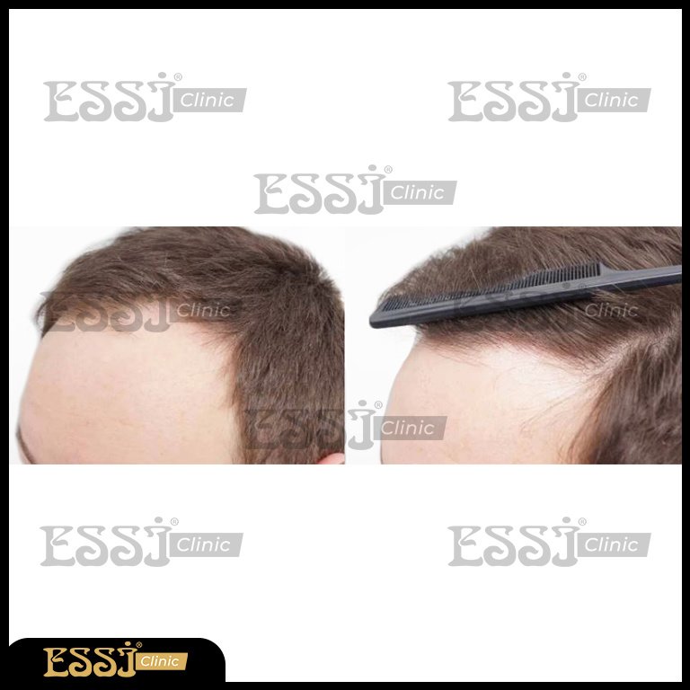 عيادة اسي لزراعة الشعر - Essi Hair Transplant Clinic