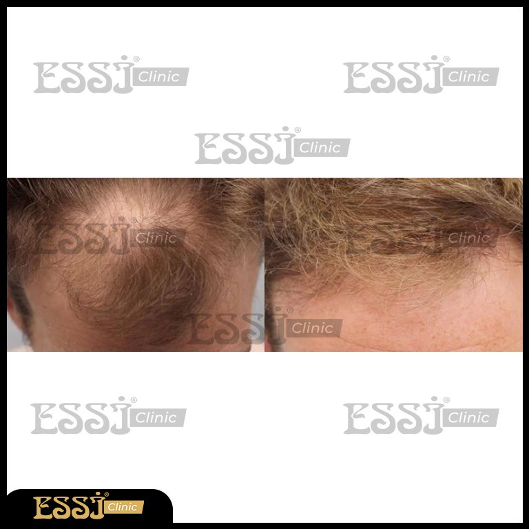 عيادة اسي لزراعة الشعر - Essi Hair Transplant Clinic