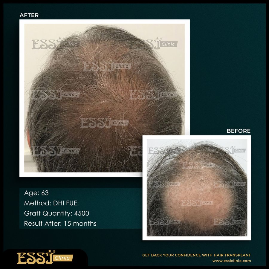 عيادة اسي لزراعة الشعر - Essi Hair Transplant Clinic