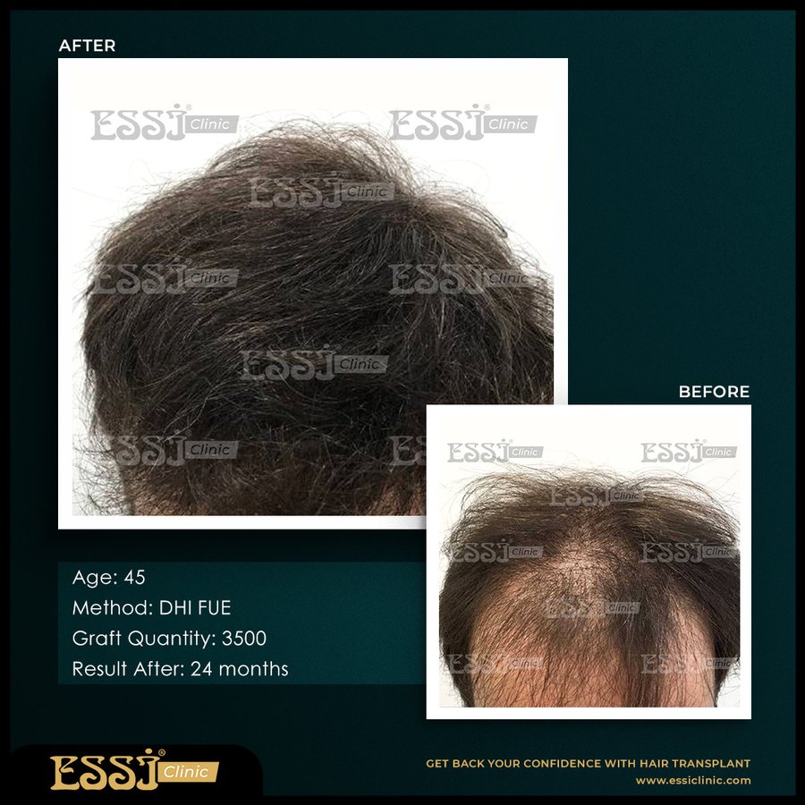 عيادة اسي لزراعة الشعر - Essi Hair Transplant Clinic