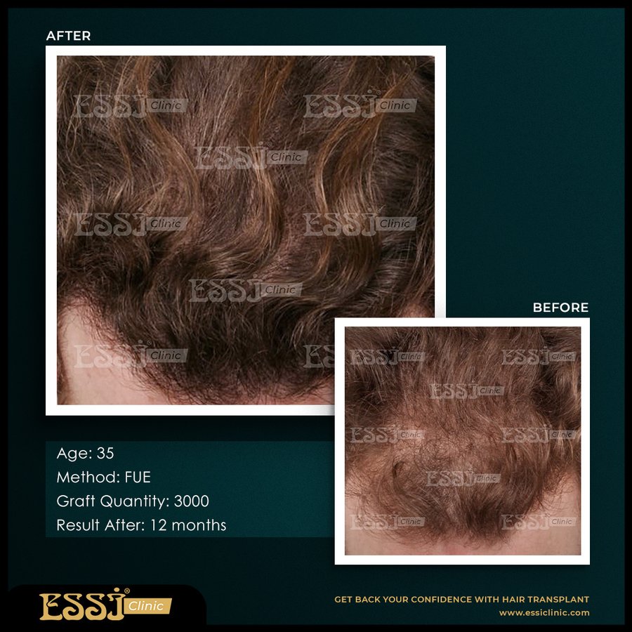 عيادة اسي لزراعة الشعر - Essi Hair Transplant Clinic