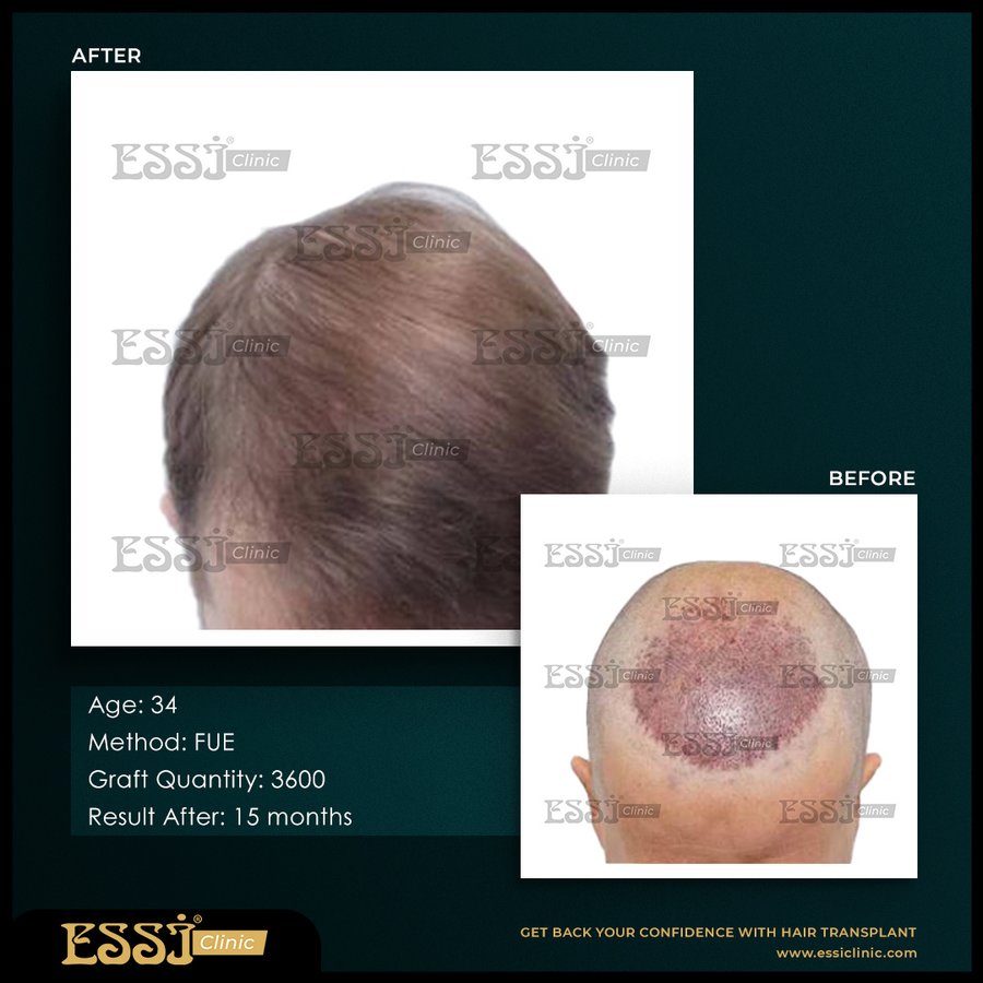 عيادة اسي لزراعة الشعر - Essi Hair Transplant Clinic