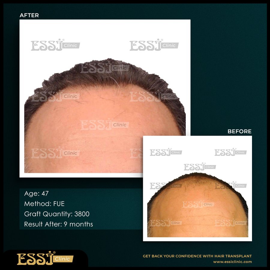 عيادة اسي لزراعة الشعر - Essi Hair Transplant Clinic