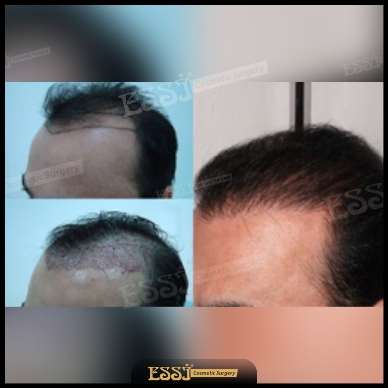 عيادة اسي لزراعة الشعر - Essi Hair Transplant Clinic